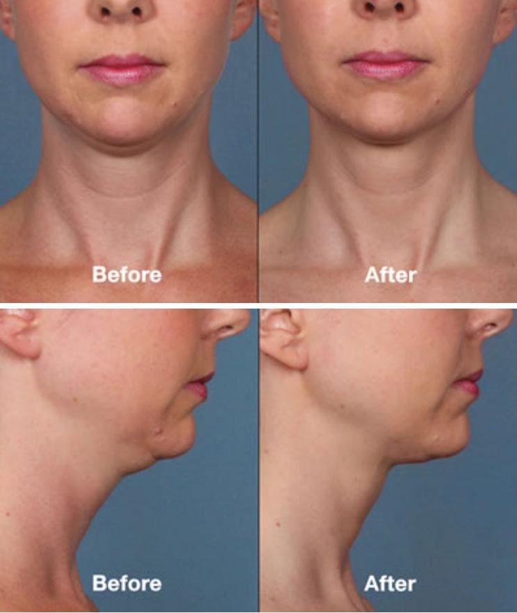 Deoxycholic before and after